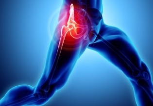 Piriformis Syndrome
