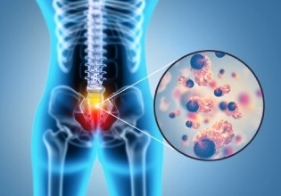 degenerative disc disease