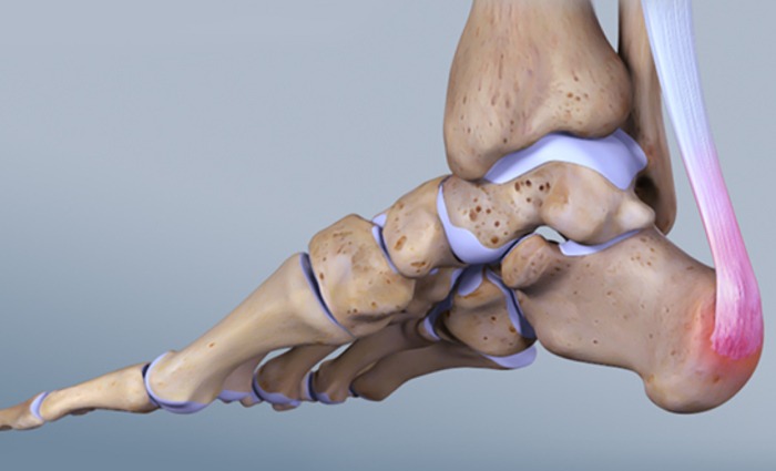 Achilles Tendinitis1