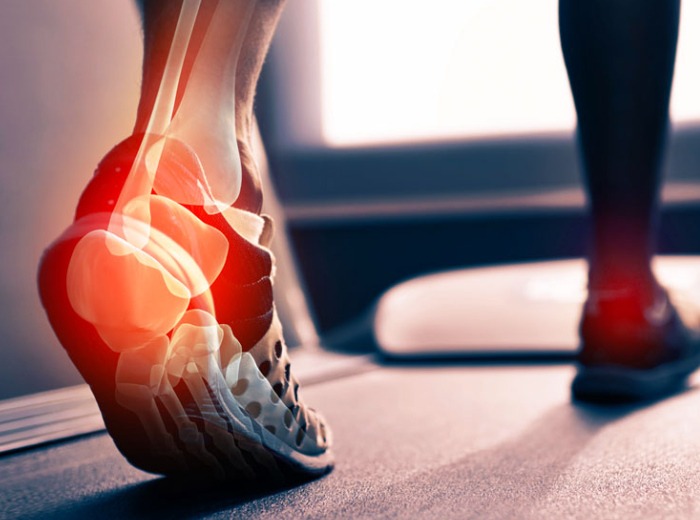 Achilles Tendinitis2
