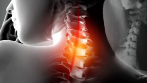 Cervical Instability: Causes, Pathogenesis, Symptoms, Diagnosis, and Treatment with a Focus on Prolotherapy and PRP