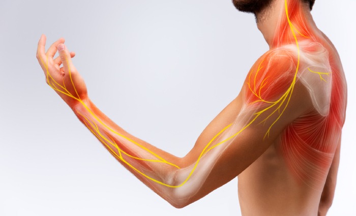 Cervical Radiculopathy Pain1
