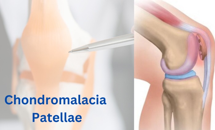Chondromalacia Patellae1