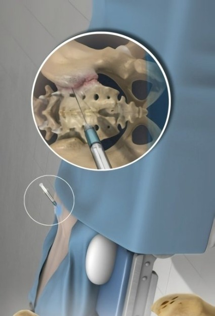 Diagnostic Injections_ Facet Joint Syndrome