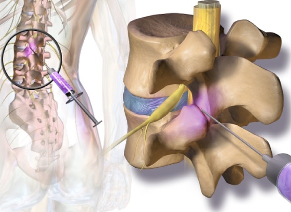 Facet Joint Syndrome-injuction