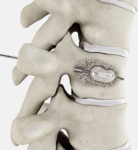 Kyphoplasty2