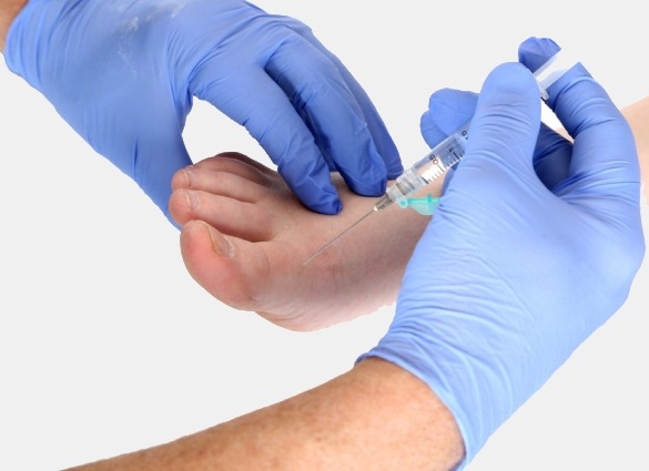 PRP, Prolotherapy treatment for foot