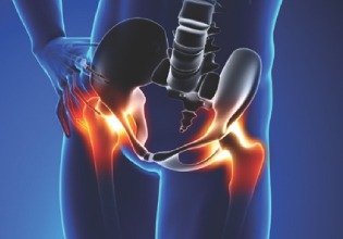 Piriformis Syndrome-prevention