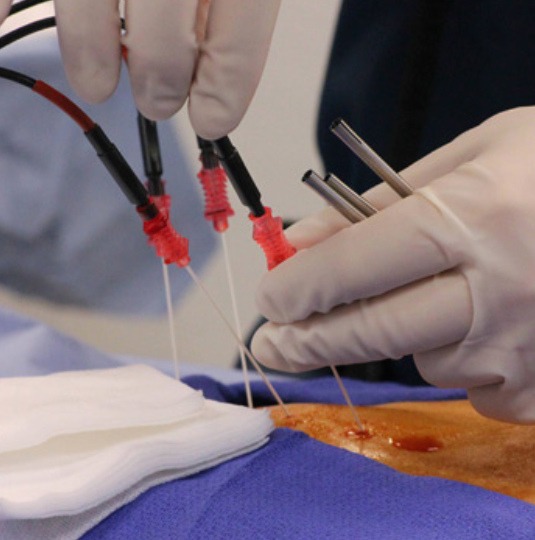 Radiofrequency Ablation2