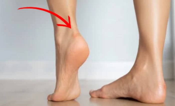 Retrocalcaneal Bursitis1