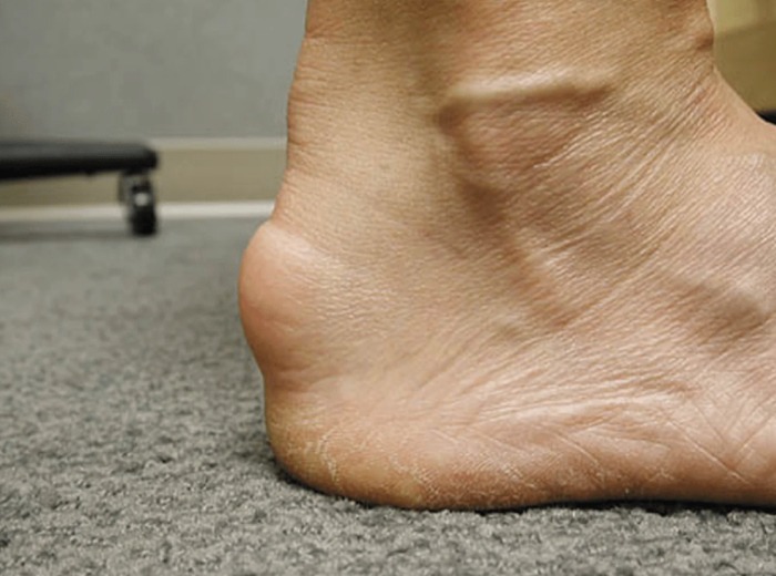 Retrocalcaneal Bursitis2