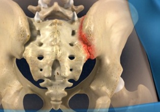 Sacroiliac 1 Joint Dysfunction-
