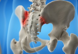 Sacroiliac Joint symptoms