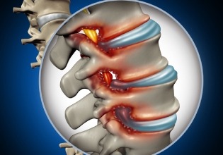 Spinal Canal Stenosis-symptoms