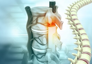 Spinal Canal Stenosis
