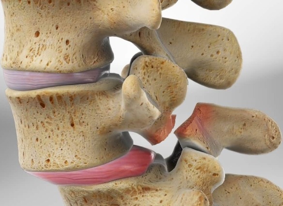 Spondylolisthesis1
