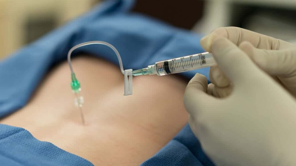 Transforaminal Epidural Injections: What to Expect