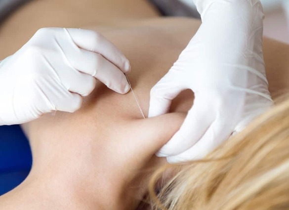 Trigger Point Interventions