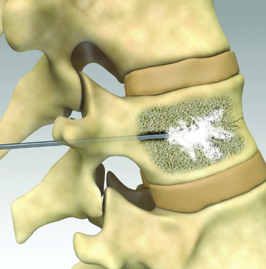 Vertebroplasty2