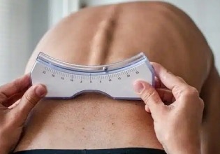 diagnosis Scoliosis