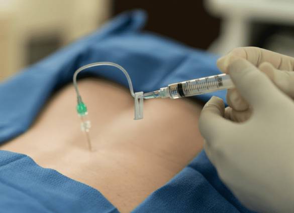 epidural steroid injections