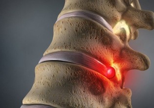 herniated discs symptoms