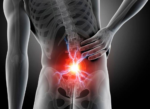 lumbar radiculopathy-1