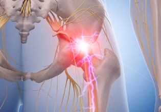 lumbar radiculopathy