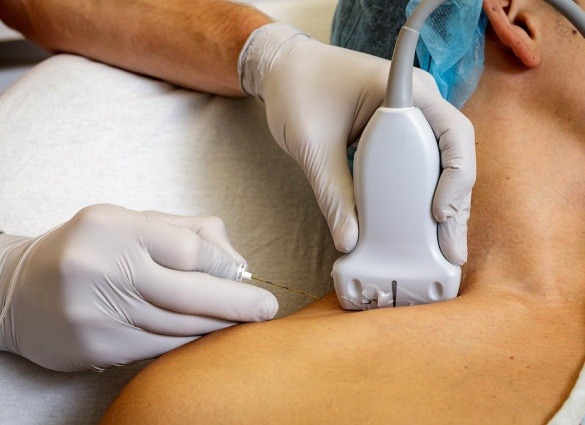 nerve blocks