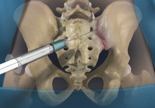 prevention-Sacroiliac Joint Dysfunction