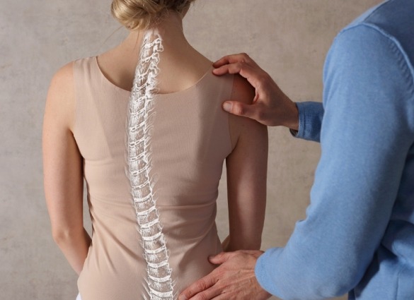 prevention Scoliosis