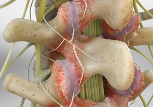 symptoms facet joint syndrome