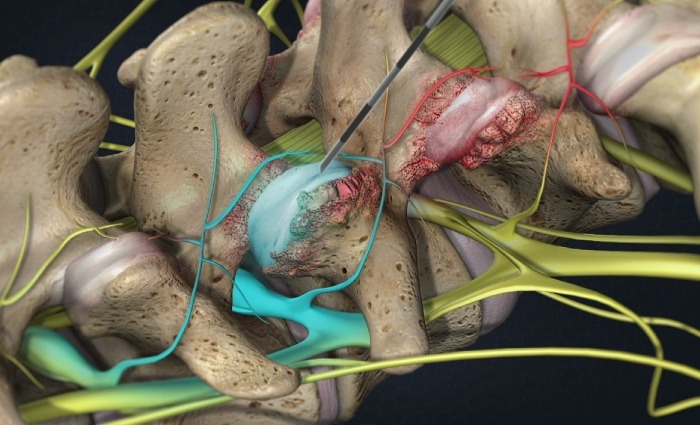 what is facet joint syndrome