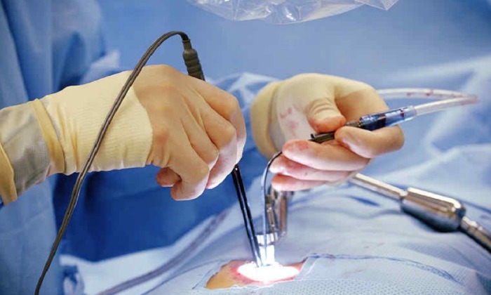 Endoscopic Discectomy1