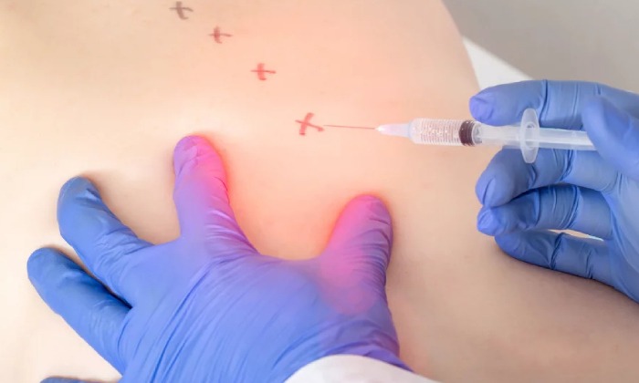 Intercostal Nerve Block