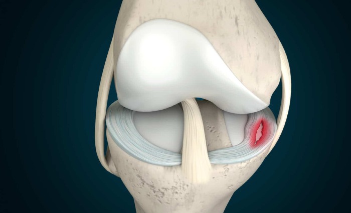 Knee Meniscal Tear1