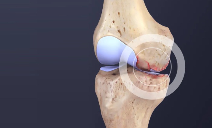 Knee Osteoarthritis1
