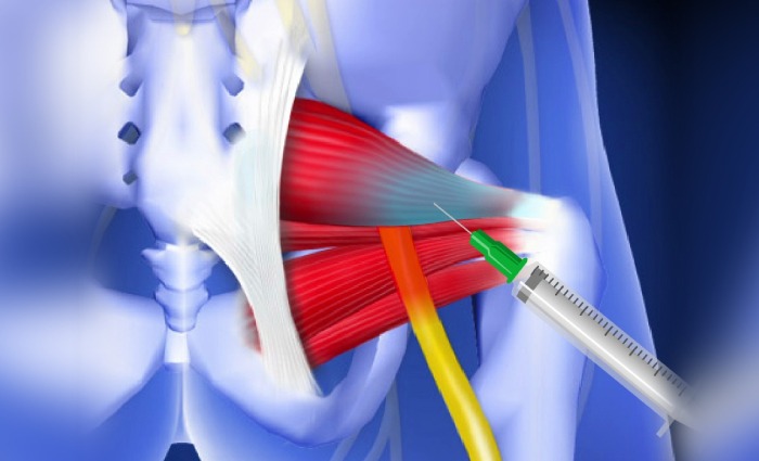 Piriformis Syndrome-new