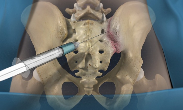 Sacroiliac Joint Injection1