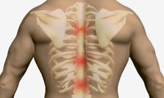 T2-T3 vertebral