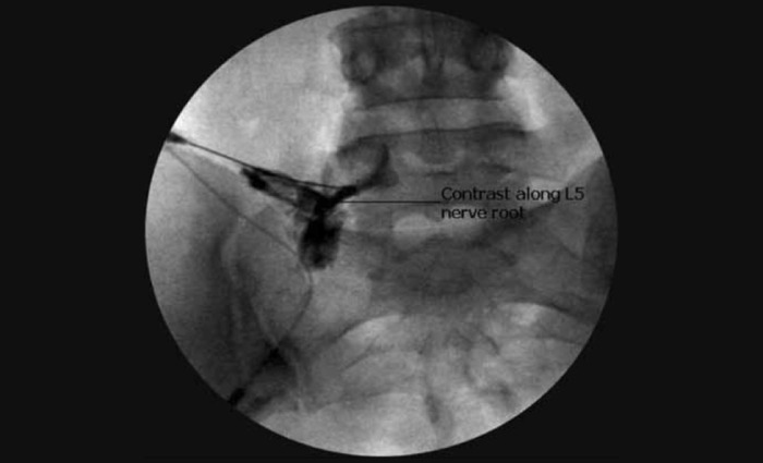 What is a Herniated Disc_