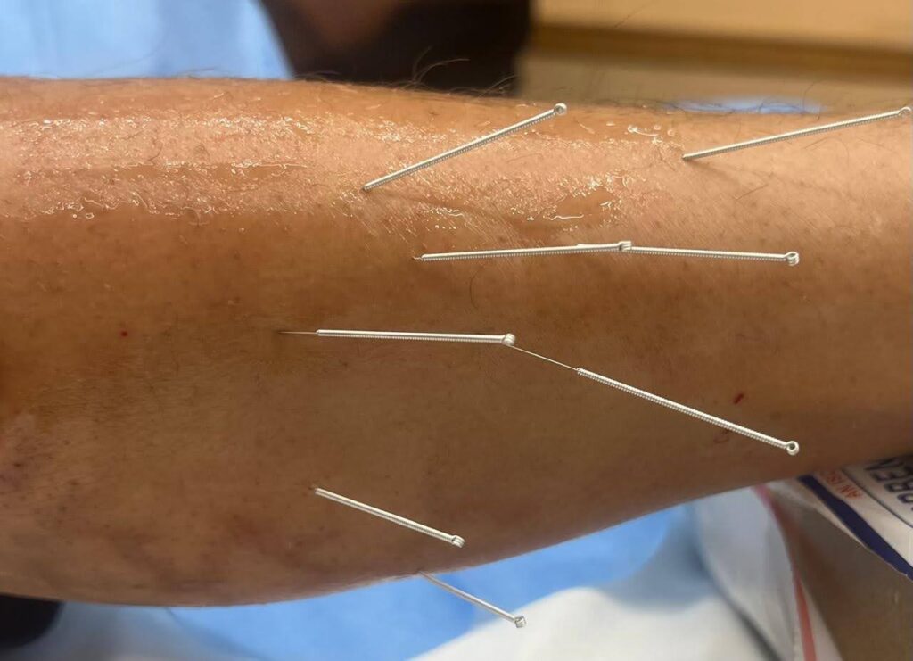 Ultrasound-Guided Dry Needling for Neuropathic Pain: A Precise, Modern Approach
