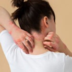 Post-Herpetic Neuralgia: Understanding and Managing the Pain After Shingles