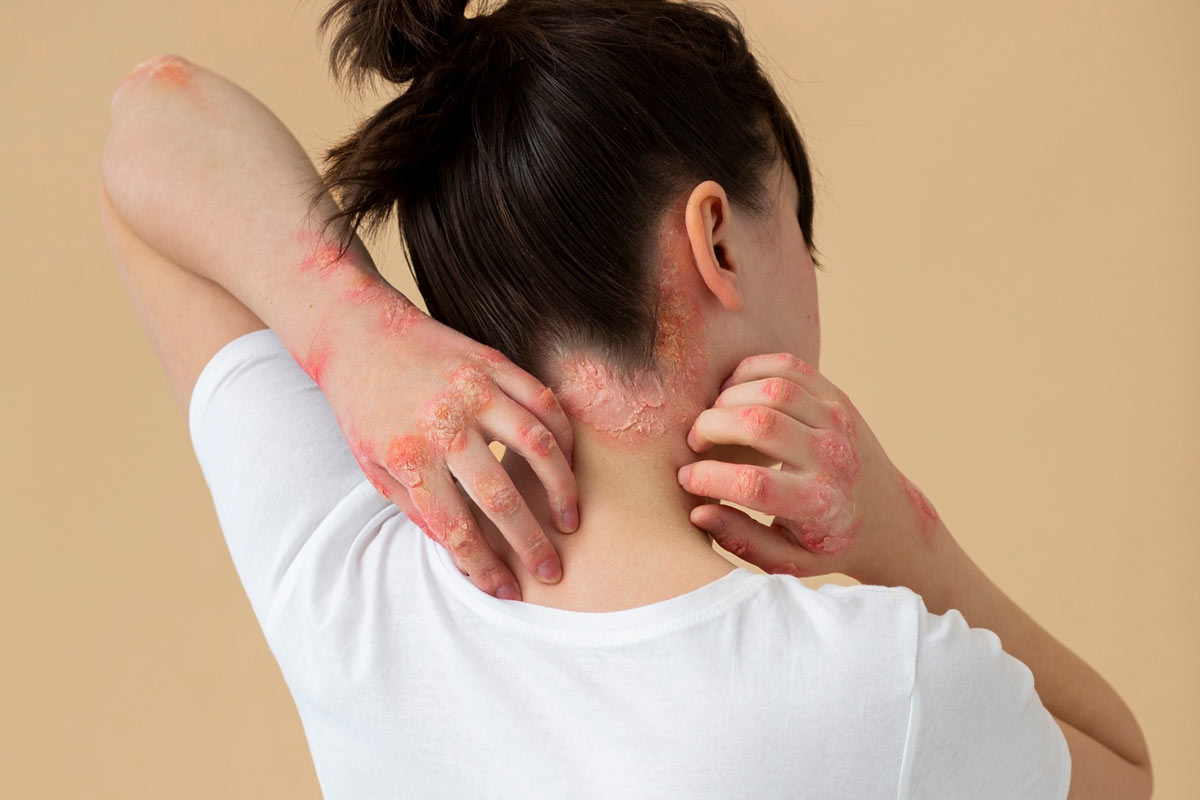 Post-Herpetic Neuralgia: Pain Management After Shingles
